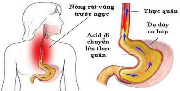trào ngược dạ dày thực quản