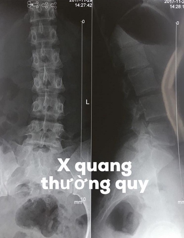 u tủy sống vùng đuôi ngựa
