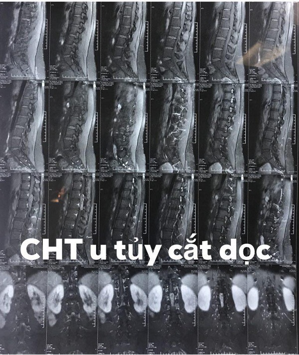 u tủy sống vùng đuôi ngựa