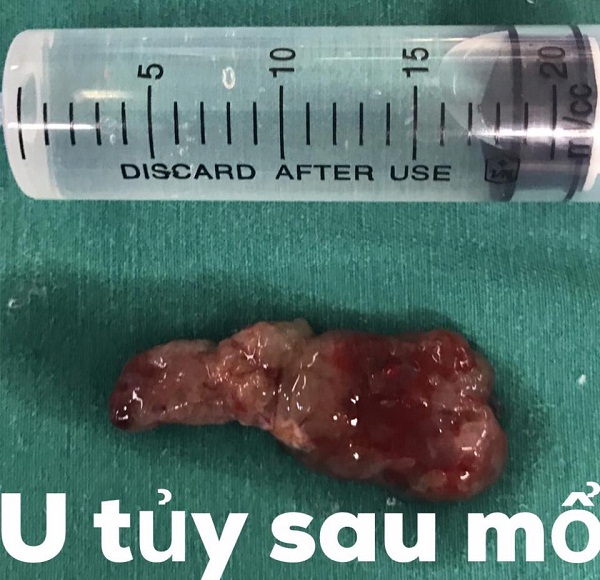 u tủy sống vùng đuôi ngựa