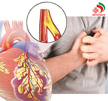 bệnh động mạch vành