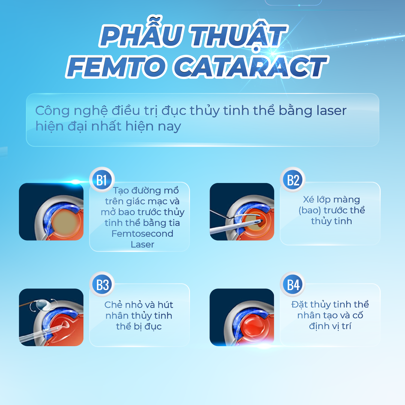 Điều trị đục thủy tinh thể bằng phương pháp Femto Cataract 