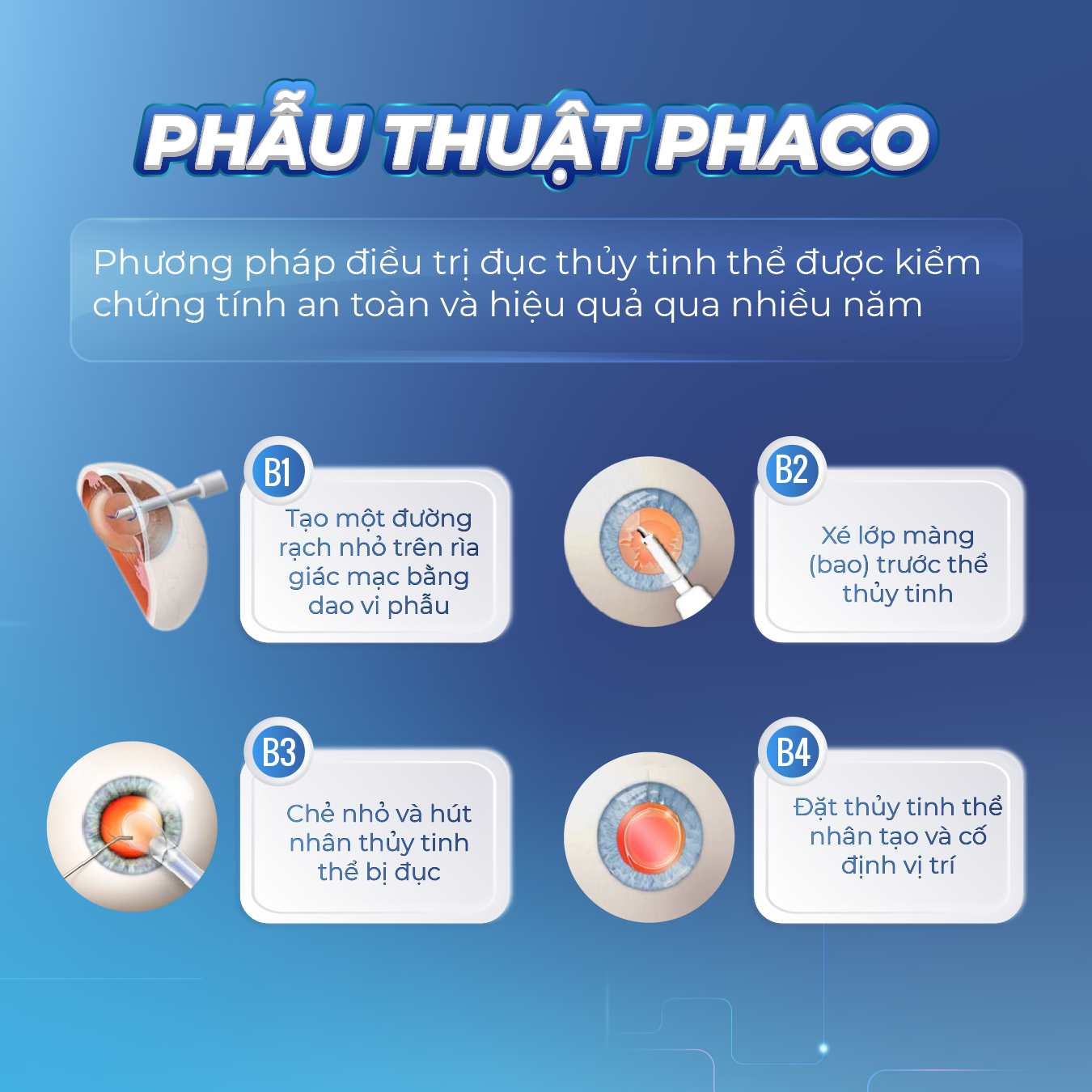 Điều trị đục thủy tinh thể bằng phương pháp Phaco 