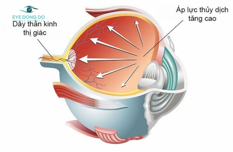 Nguyên nhân bệnh tăng nhãn áp