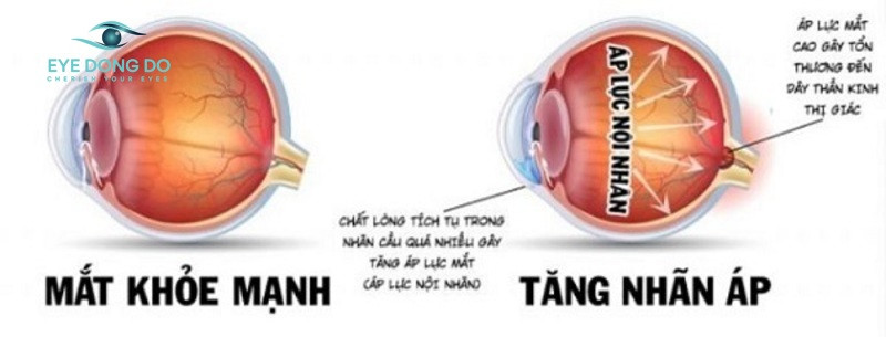 Bệnh tăng nhãn áp làm tổn thương dây thần kinh thị giác của bệnh nhân