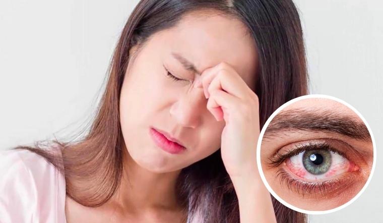 Đau mắt đỏ / Viêm kết mạc bệnh lý về mắt hay gặp trong ngày hè