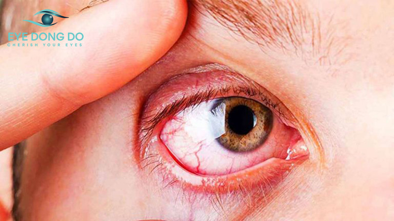 Sưng giác mạc là biến chứng sau phẫu thuật đục thủy tinh thể