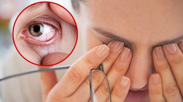 Người bệnh có thể gặp biến chứng khô mắt sau khi mổ mộng thịt