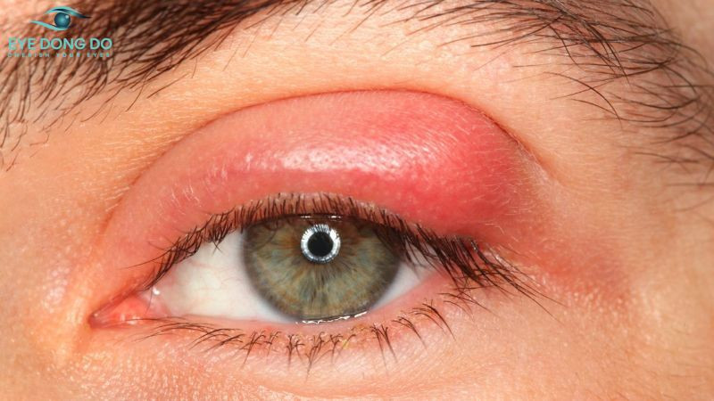 Lên chắp lẹo do sự xâm nhập của vi khuẩn, tụ cầu