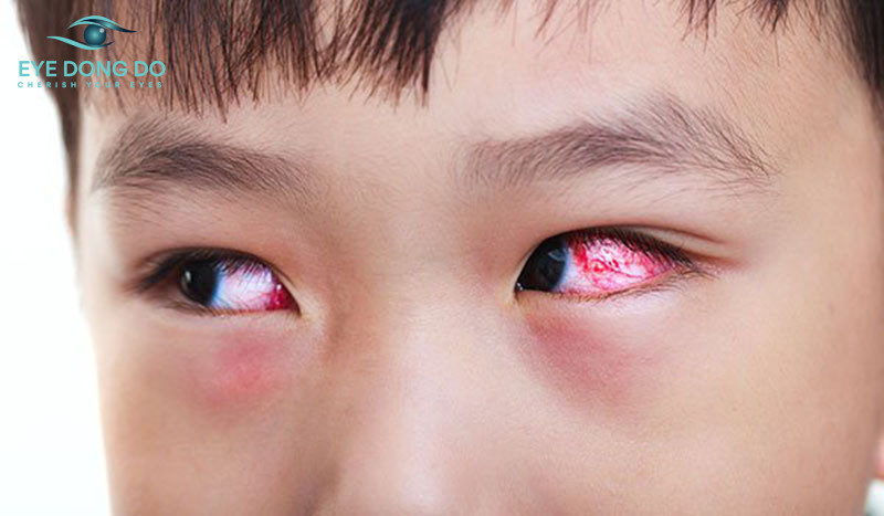 Đau mắt đỏ cũng là một trong những bệnh lý về mắt ở trẻ em