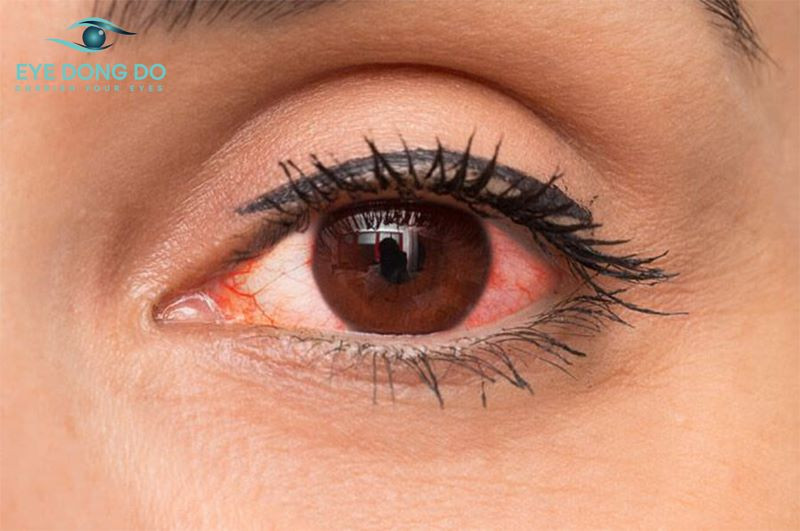 Lưu ý khi sử dụng kính áp tròng để tránh gây hại cho mắt