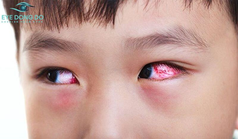 Chảy máu mắt xảy ra ở mọi lứa tuổi