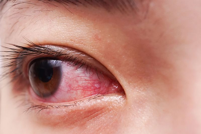 Mắc bệnh lý nhãn khoa là nguyên nhân gây chớp mắt thấy đau hốc mắt