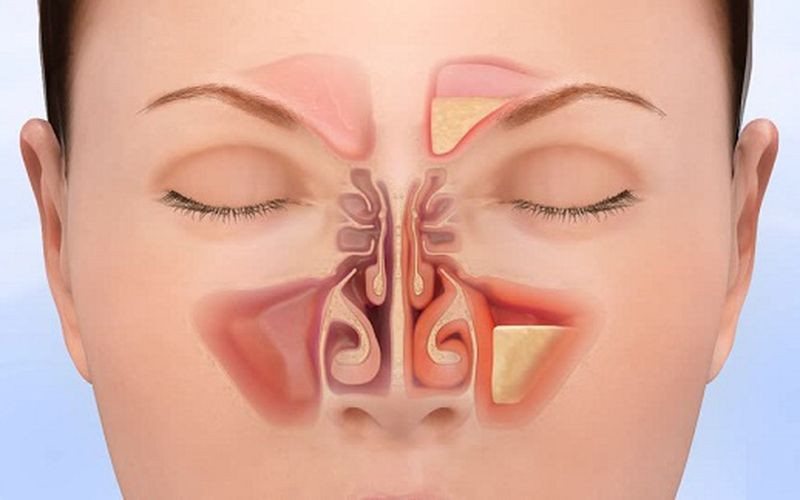 Viêm xoang có thể là nguyên nhân gây ra tình trạng chợp mắt đau hốc mắt 