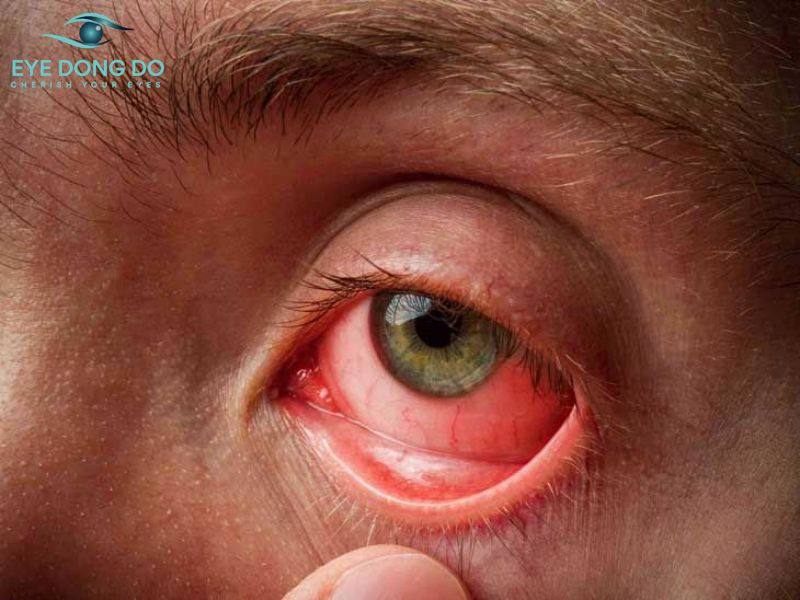 Người trên 40 tuổi dễ mắc bệnh cườm nước