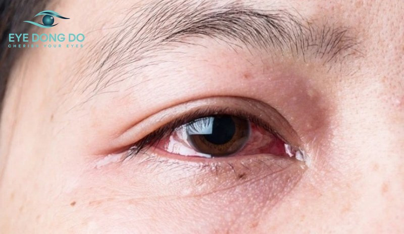 Đau mắt đỏ lâu khỏi có thể gây biến chứng nặng nề