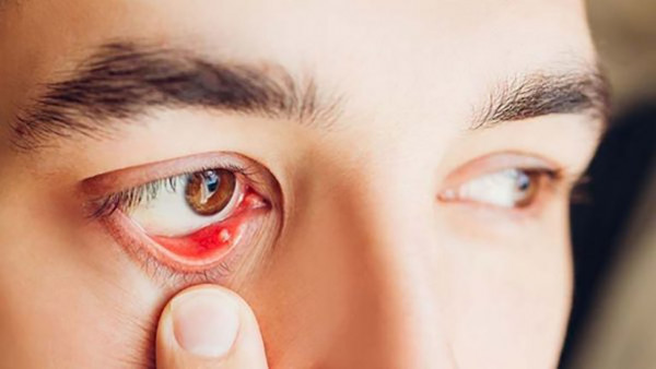 Đau mắt hột bao lâu thì khỏi là vấn đề nhiều người quan tâm