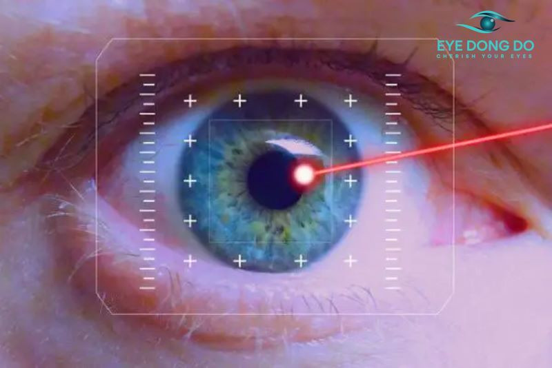 Điều trị tăng nhãn áp bằng tia laser
