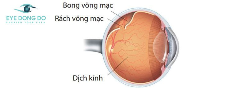 Tình trạng làm gia tăng nguy cơ bong võng mạc