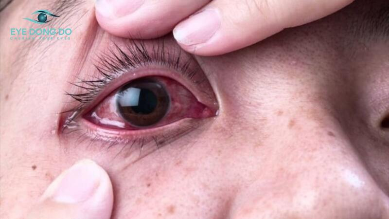 Nguyên nhân gây lông xiêu thường do sẹo bờ mi sau phẫu thuật 