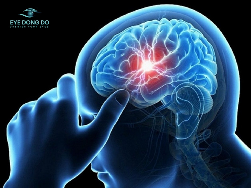Thiếu máu não cục bộ cũng là nguyên nhân gây ra mắt mờ