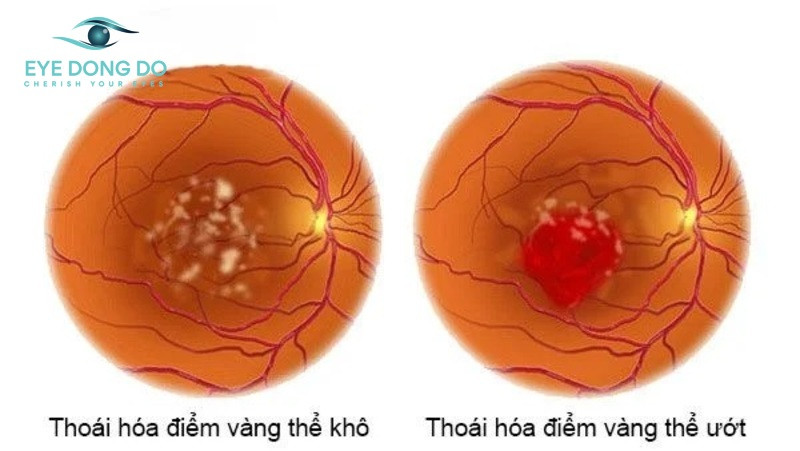 Các thể bệnh thoái hóa điểm vàng