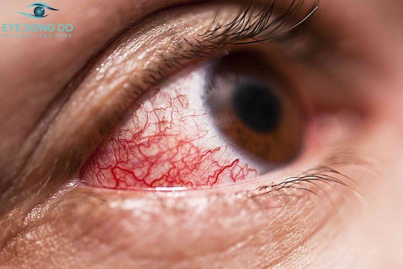 Viêm màng bồ đều gây ra tình trạng vẩn đục dịch kính