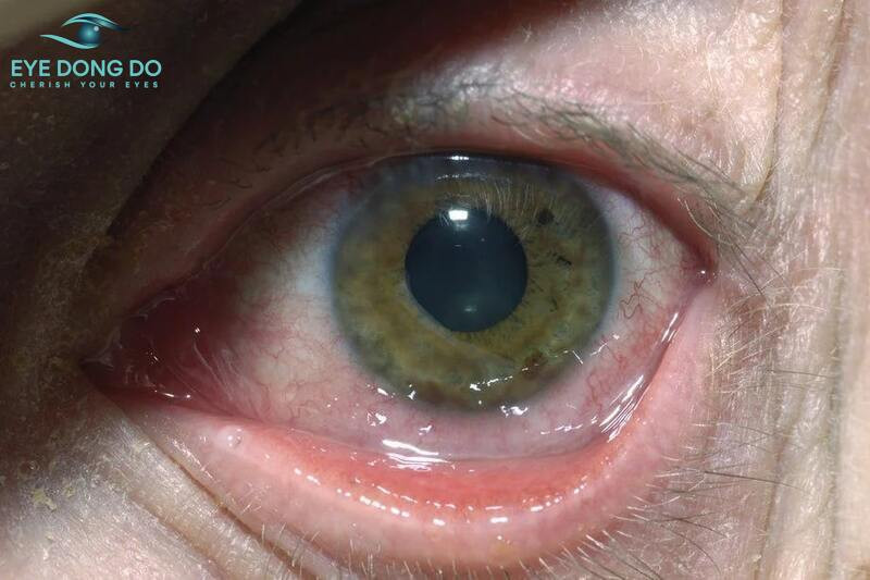 Triệu chứng khi mắc bệnh viêm giác mạc do virus herpes