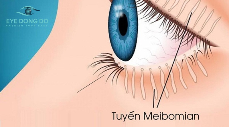 Viêm bờ mi mắt mãn tính