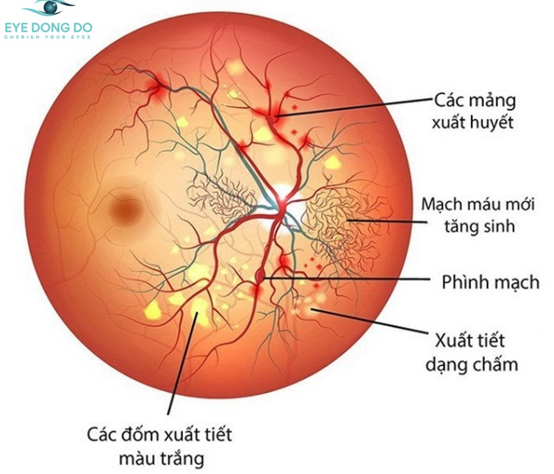 Bệnh võng mạc không tăng sinh