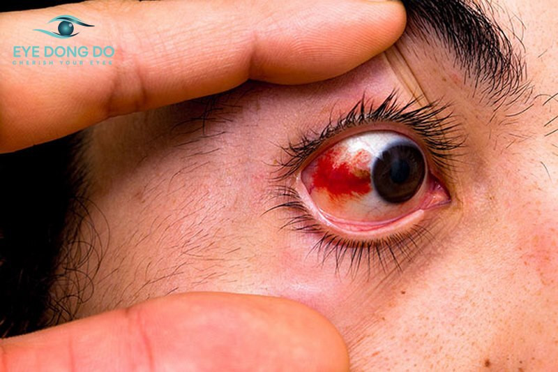 Bệnh xuất huyết võng mạc có thể gây mất thị lực vĩnh viễn