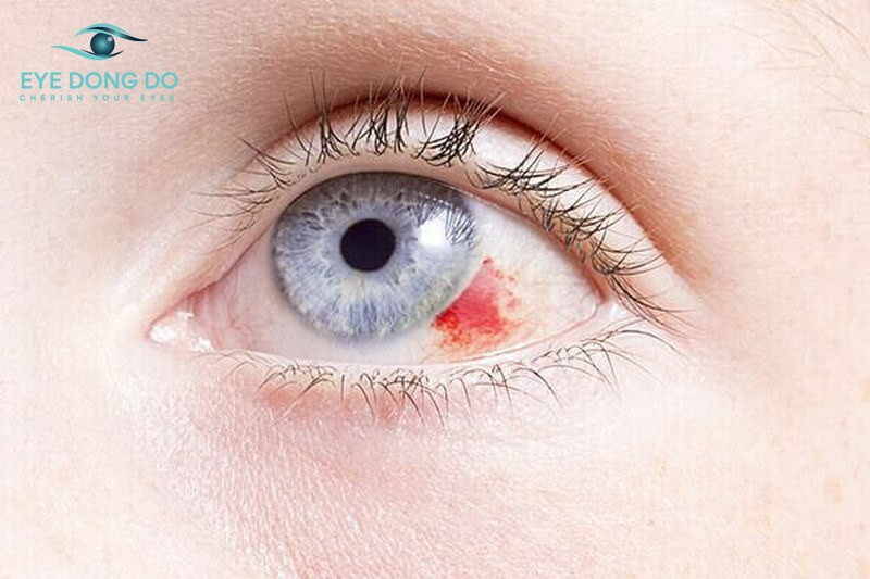 Xuất huyết võng mạc có thể được điều trị nếu được phát hiện kịp thời