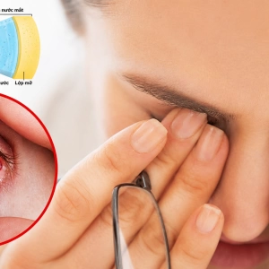 Bệnh khô mắt: Khi “Hệ sinh thái” nhãn cầu lên tiếng
