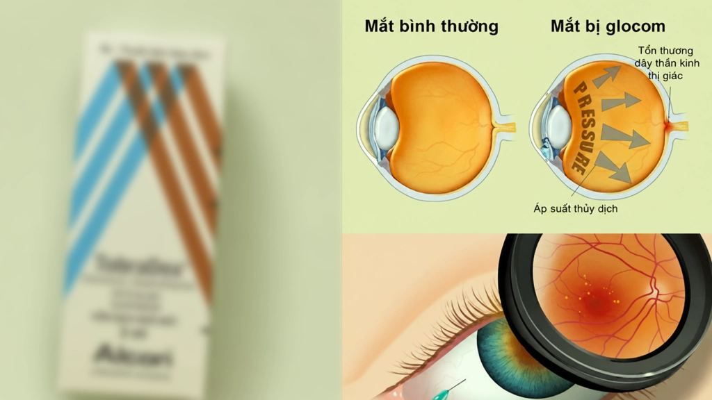 Tác hại của thuốc nhỏ mắt chứa corticoid